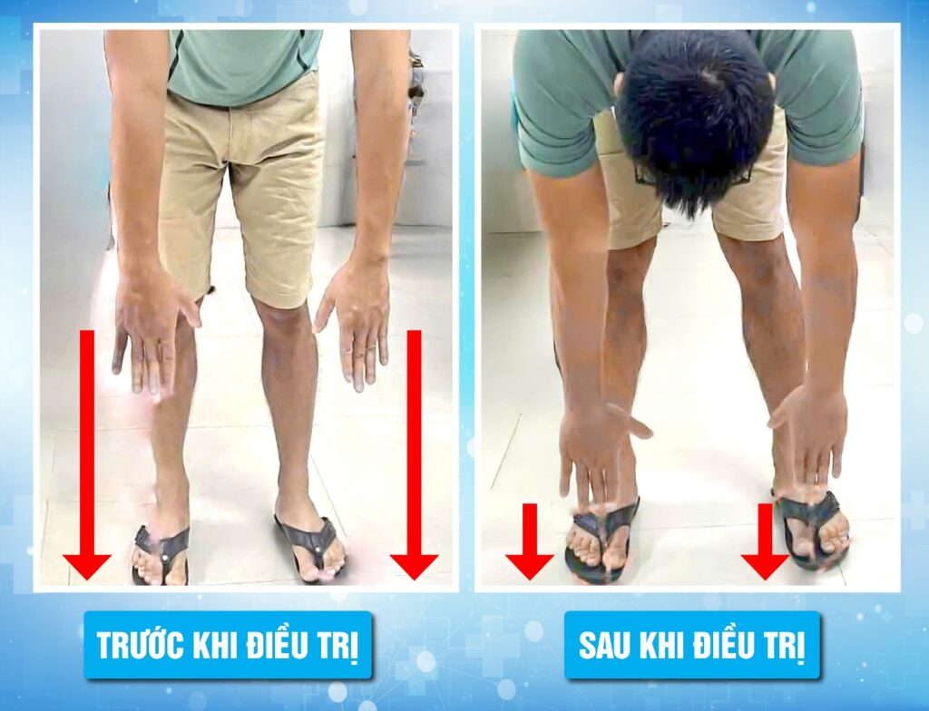 Đau thần kinh tọa