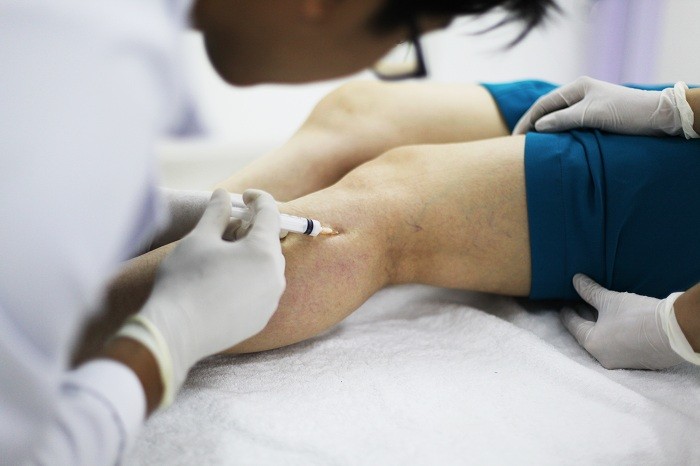 Suy giãn tĩnh mạch