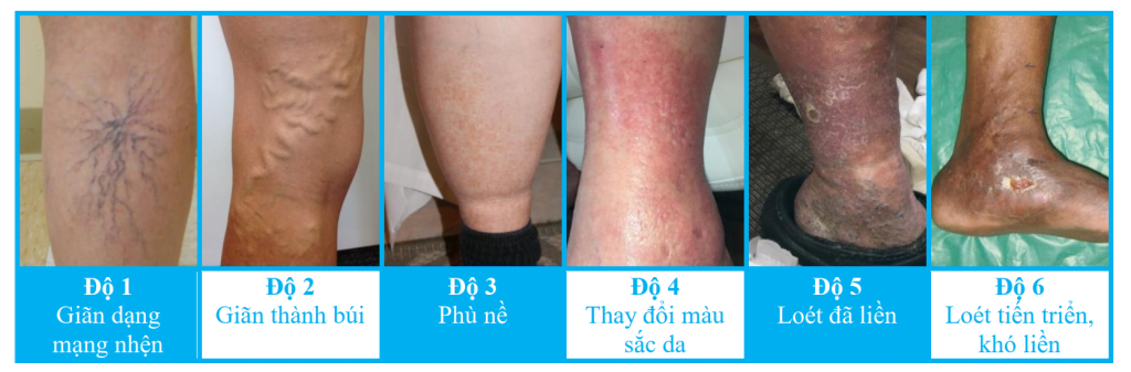 Suy giãn tĩnh mạch