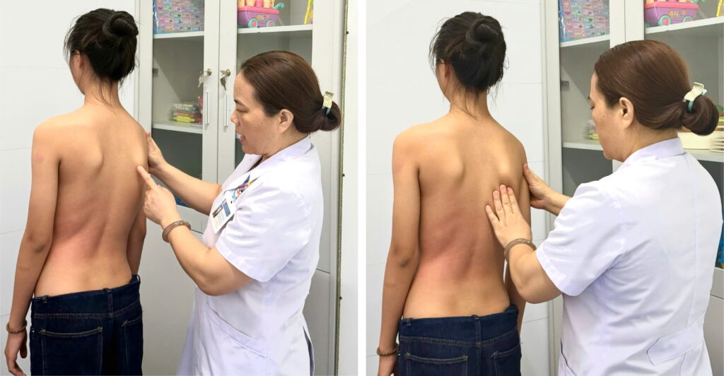 VẸO CỘT SỐNG Ở TRẺ